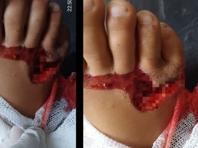 Un perro mordi� a un ni�o y le caus� graves lesiones